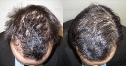 Hair growth therapy with growth factors